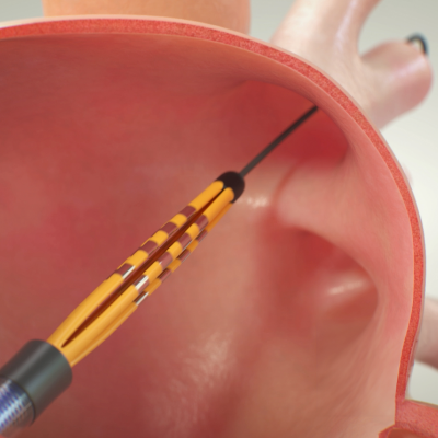 Scopri il sistema PFA e come funziona.