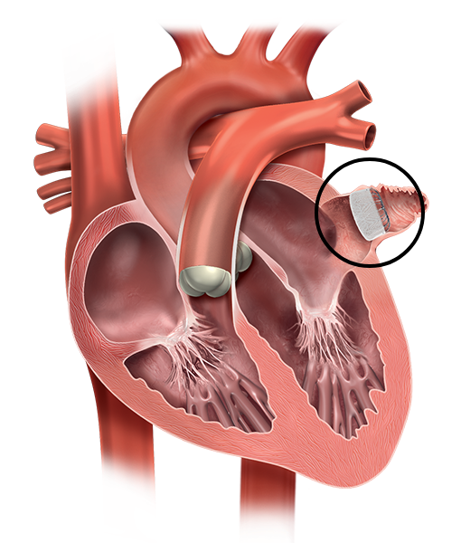 Ulteriori informazioni sulla LAAC